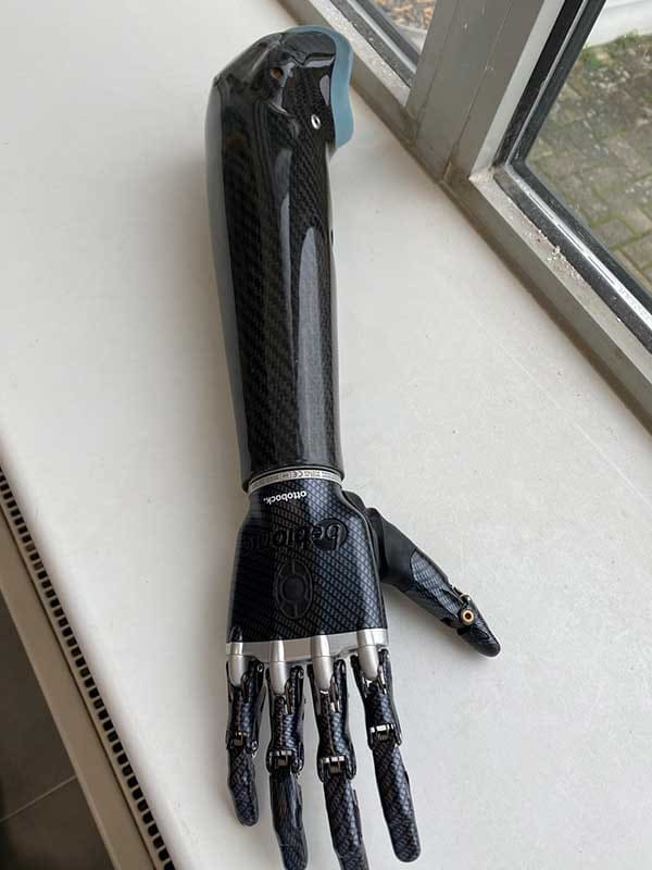 Myoelectric below-elbow prosthesis with carbon socket and Ottobock bebionic hand