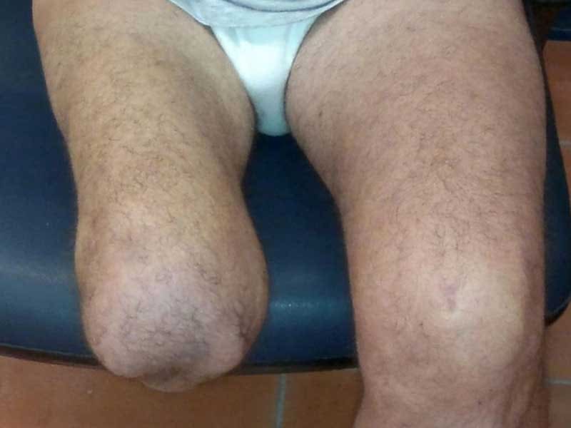 Residual limb after knee disarticulation, with the femoral condyles preserved