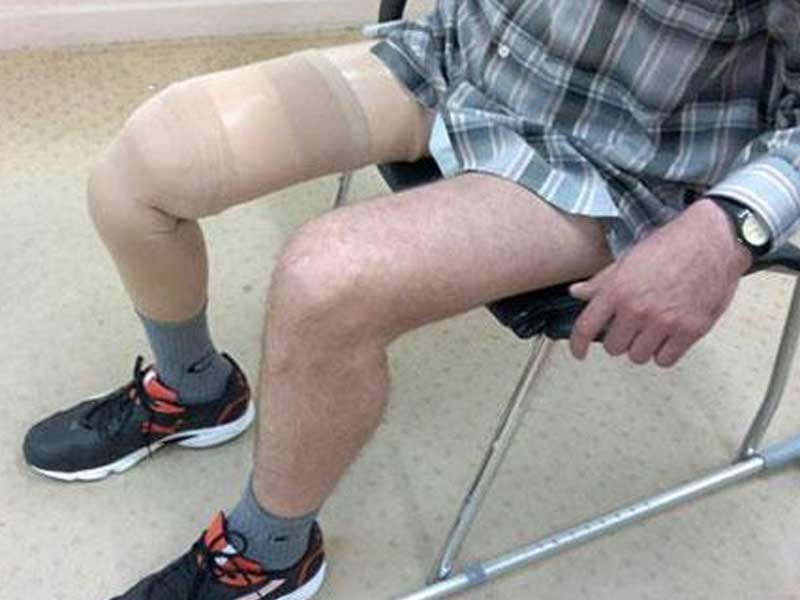 Knee disarticulation prosthesis with a skin-coloured silicone cover