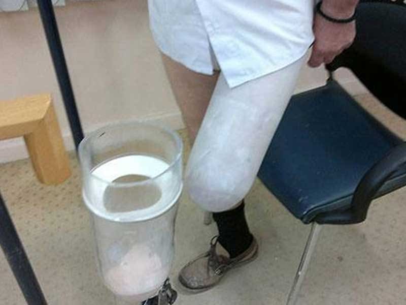 Transparent test socket for a knee disarticulation prosthesis and a cast of the residual limb