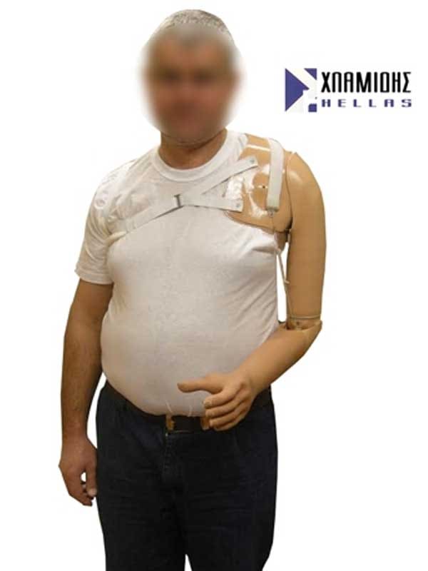 Patient with a shoulder disarticulation prosthesis and a shoulder socket with straps, Hlamidis Orthopaedic Center, Thessaloniki