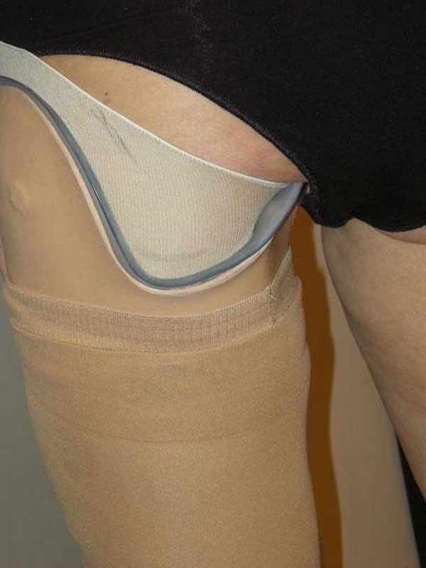 M.A.S. (Marlo Anatomical Socket) above-knee socket with a low posterior trim line that leaves the buttock free