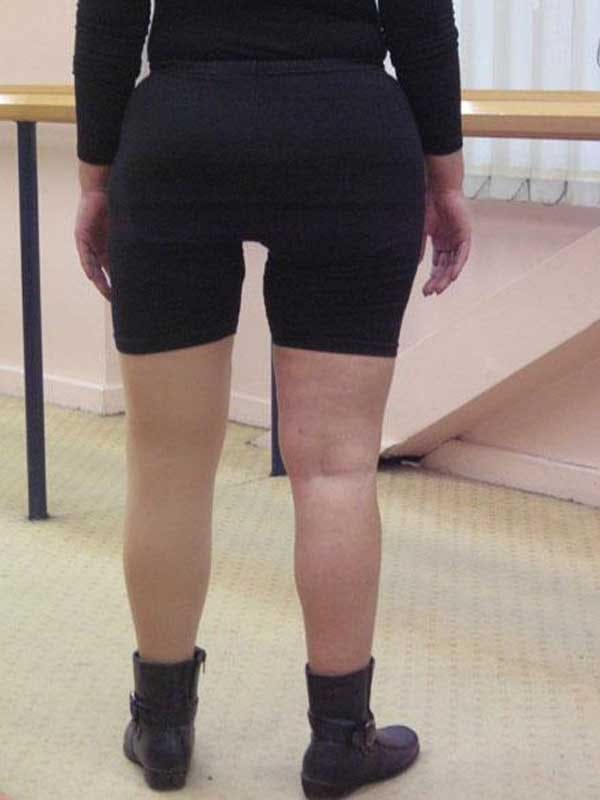 Rear view of a woman using an above-knee prosthesis with an M.A.S. socket, with a natural buttock outline under her clothes