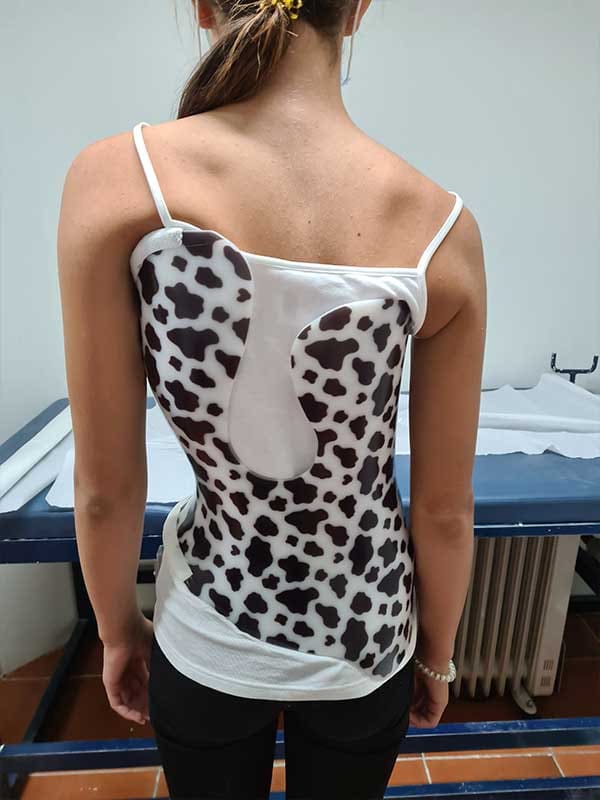 Custom Boston-type scoliosis brace, Hlamidis Orthopaedic Center, Thessaloniki