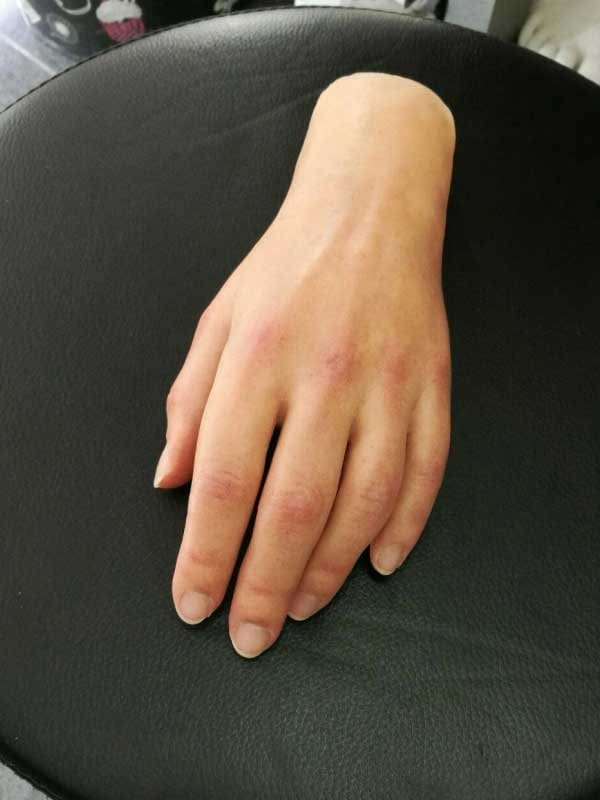 Silicone hand prosthesis with a natural appearance, nails and joints – hand prosthetics