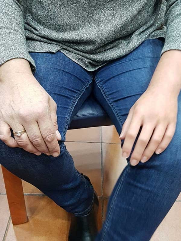 Woman with a silicone hand prosthesis on her right hand, looking natural next to her healthy hand