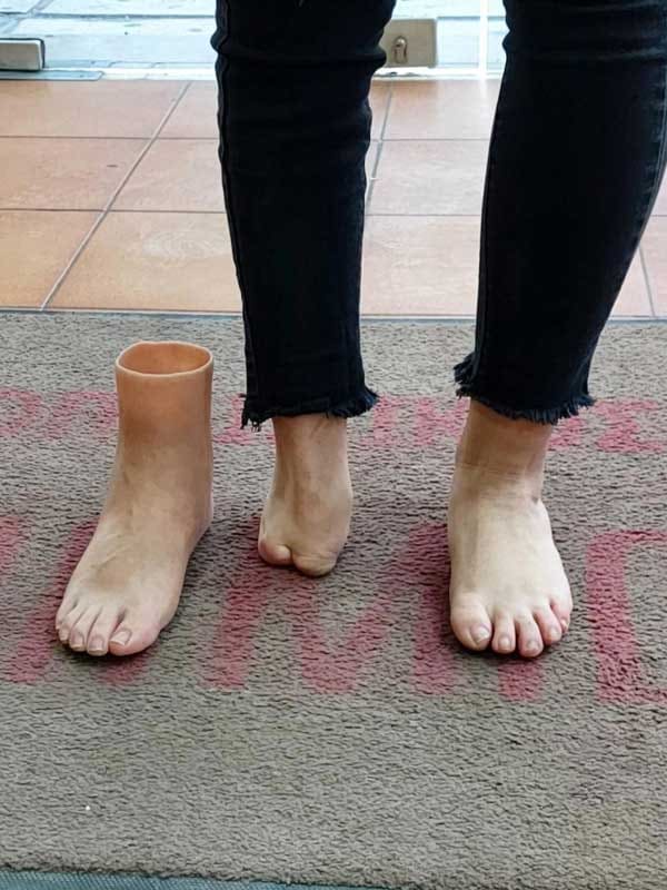 Chopart silicone prosthesis next to the residual limb after partial-foot amputation