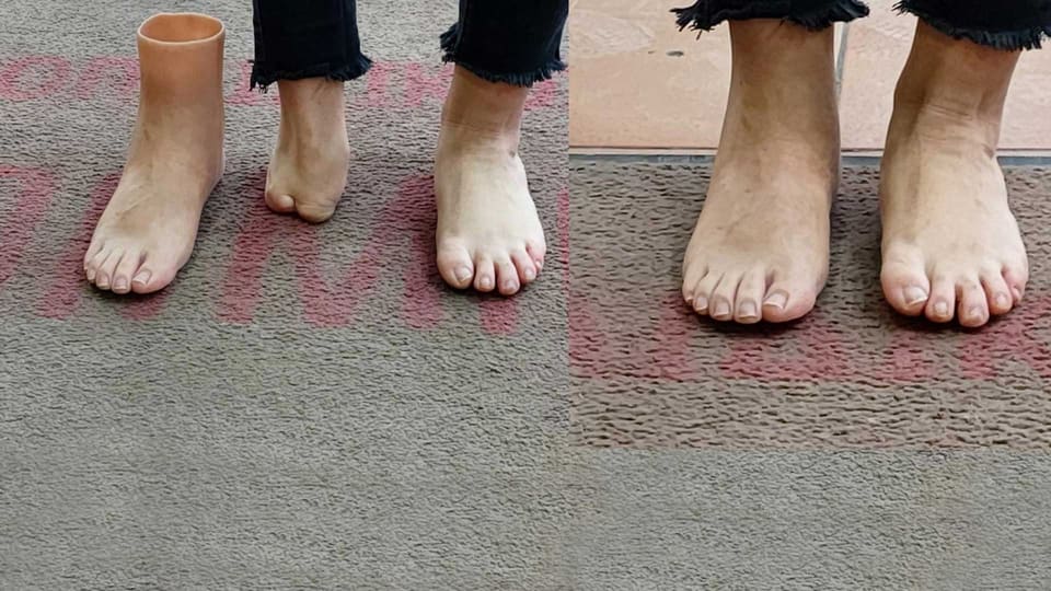 Chopart silicone partial-foot prosthesis: before and after fitting on a patient’s foot