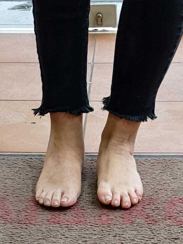A patient’s feet with a fitted Chopart silicone prosthesis, natural in appearance