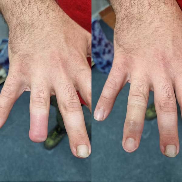Silicone finger prosthesis: before and after fitting on the hand