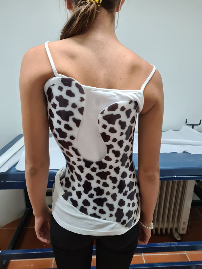 A teenage girl wearing a scoliosis brace with a decorative pattern over a thin cotton top
