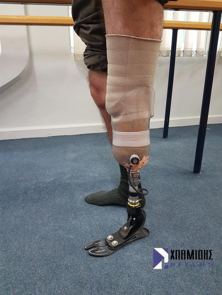 Below-knee prosthesis with a transparent test socket, vacuum system and Pro-Flex foot