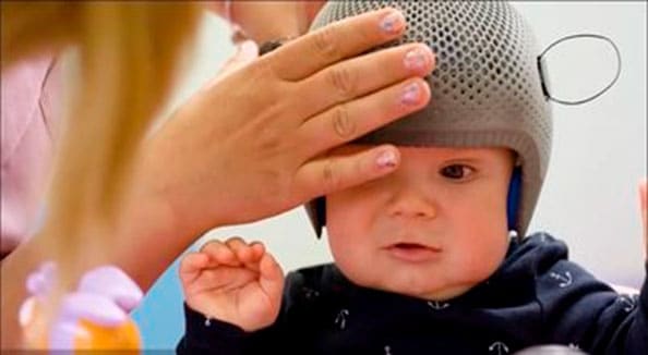 Handover of a plagiocephaly helmet at Hlamidis Orthopaedic Center