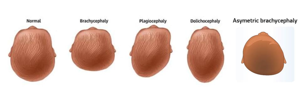 Diagram of a baby’s head seen from above: normal shape, brachycephaly, plagiocephaly, dolichocephaly and asymmetrical brachycephaly